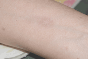 Visible lighting of bruise