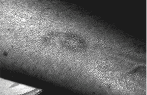 UV lighting on bruise